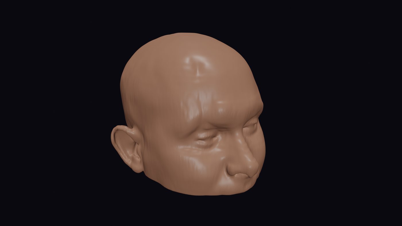 Soft tissue render showing a visible depression in the forehead before implant placement