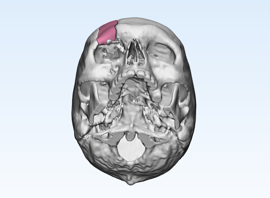 Inferior view of the skull with the defect region highlighted in pink
