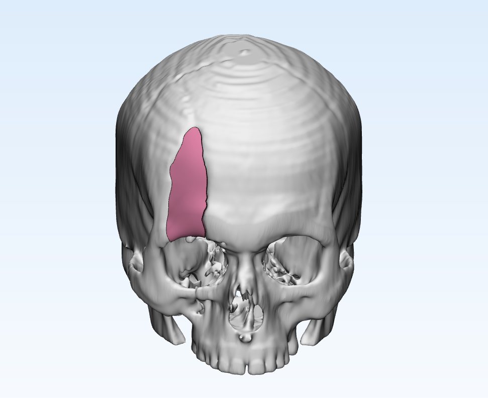 Frontal view of the skull with the supraorbital defect region highlighted in pink