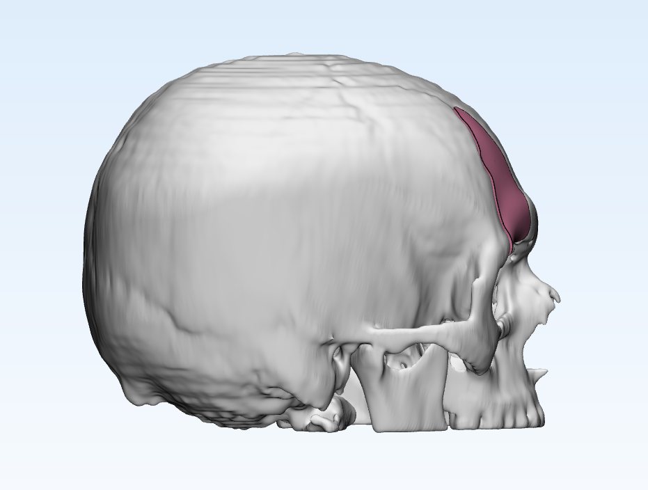 Lateral view of the skull with the defect region highlighted in pink