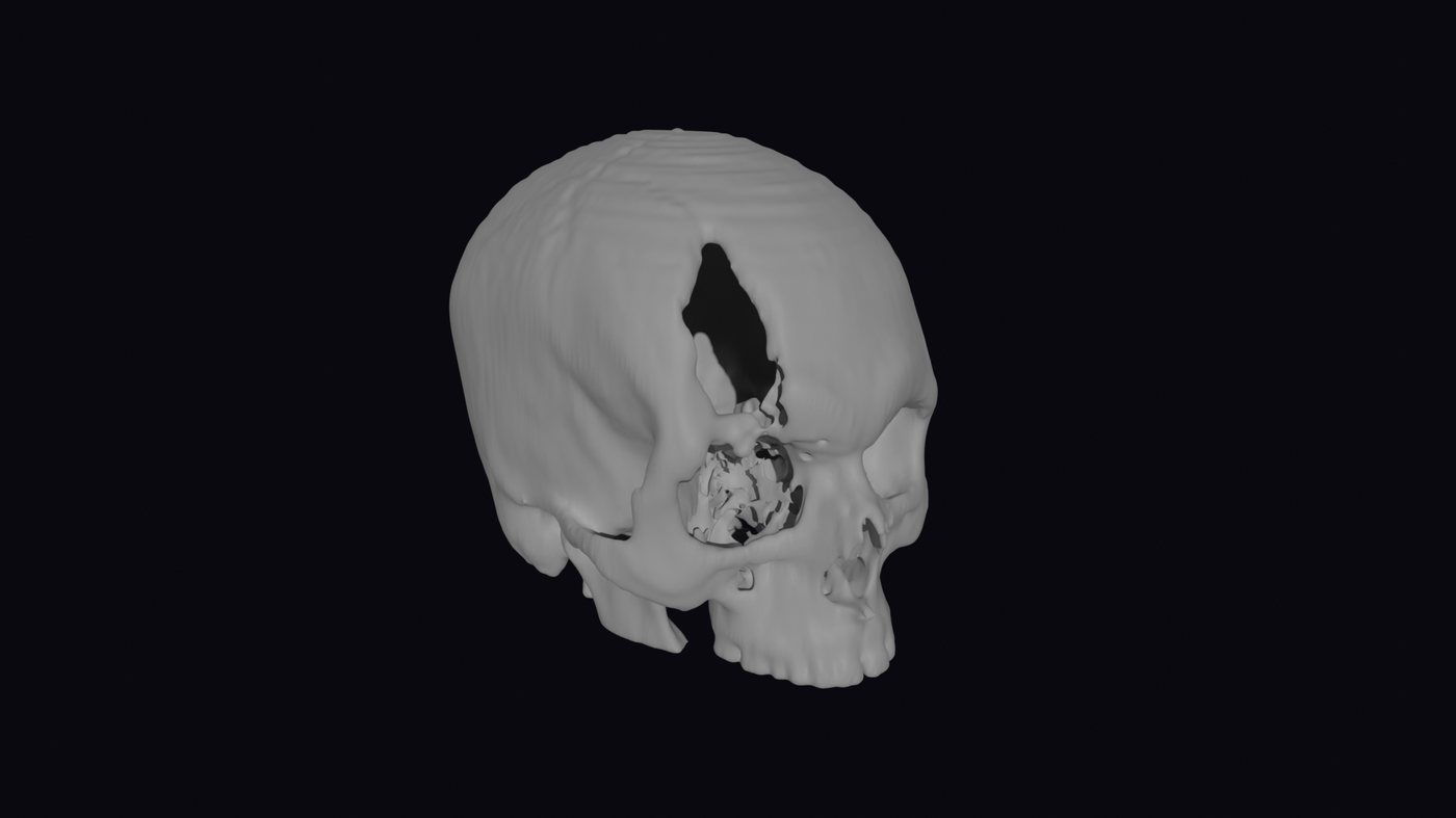 Three-quarter view of the skull showing the open cranial defect before implant design