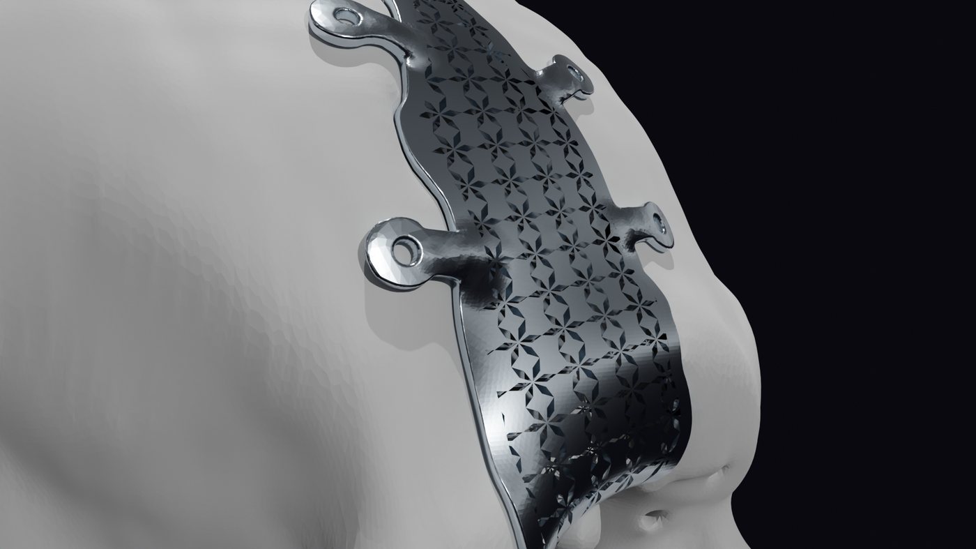 Close-up of the titanium implant showing the perforated lattice pattern and fixation tabs