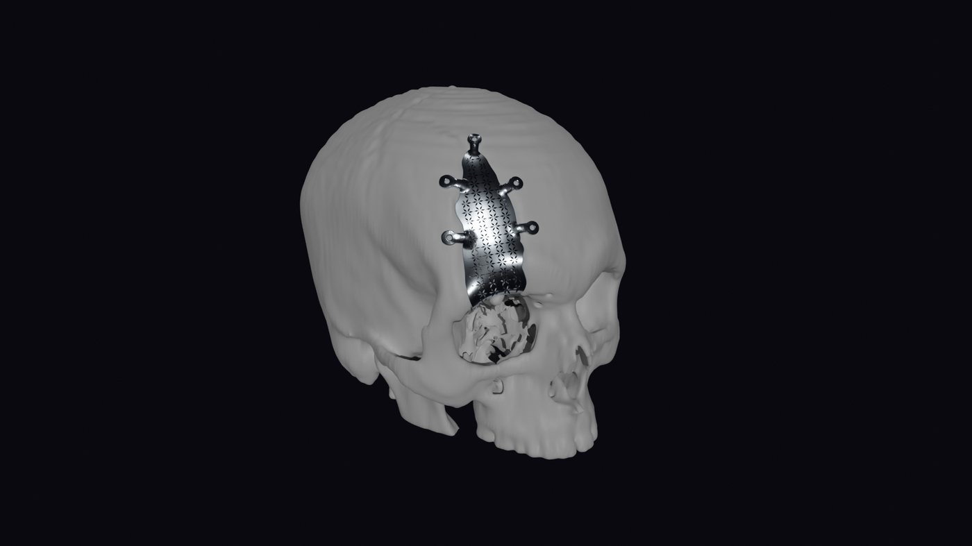 Skull with the titanium implant seated in the supraorbital defect