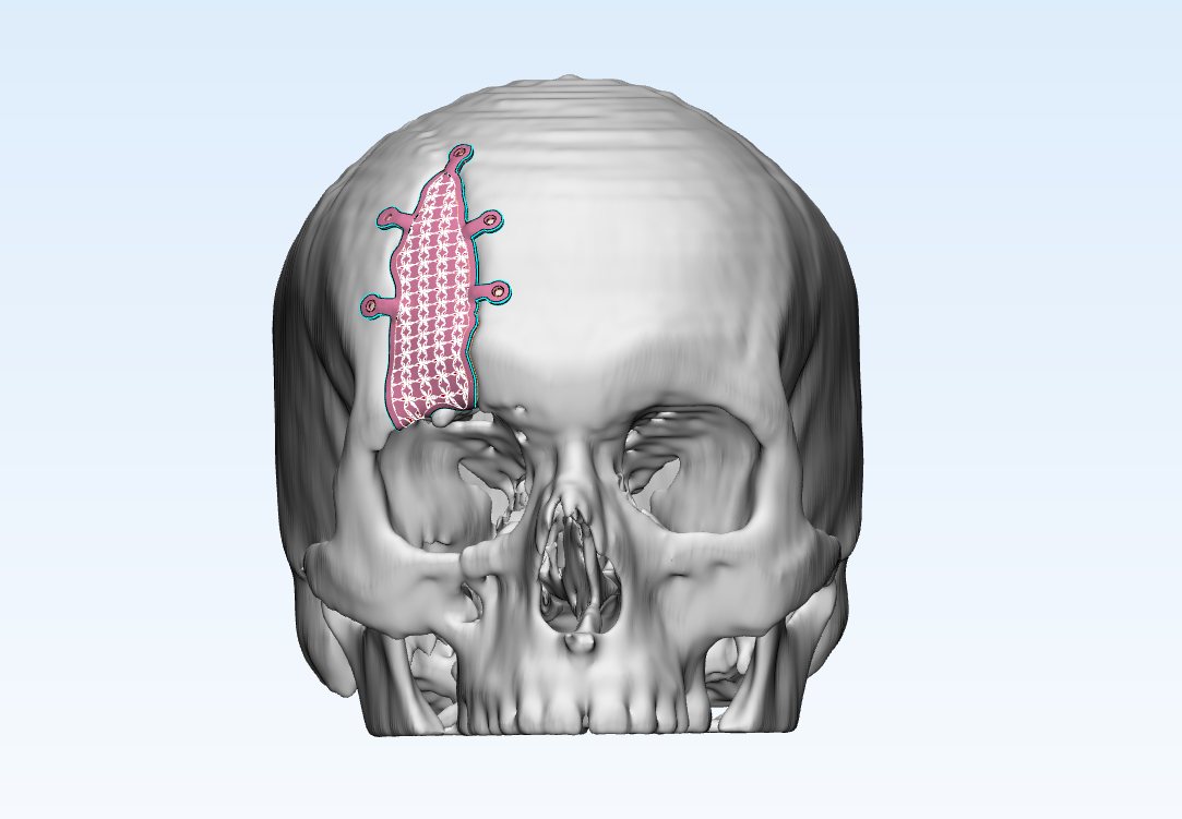 Frontal view of the finalised implant placement plan on the skull