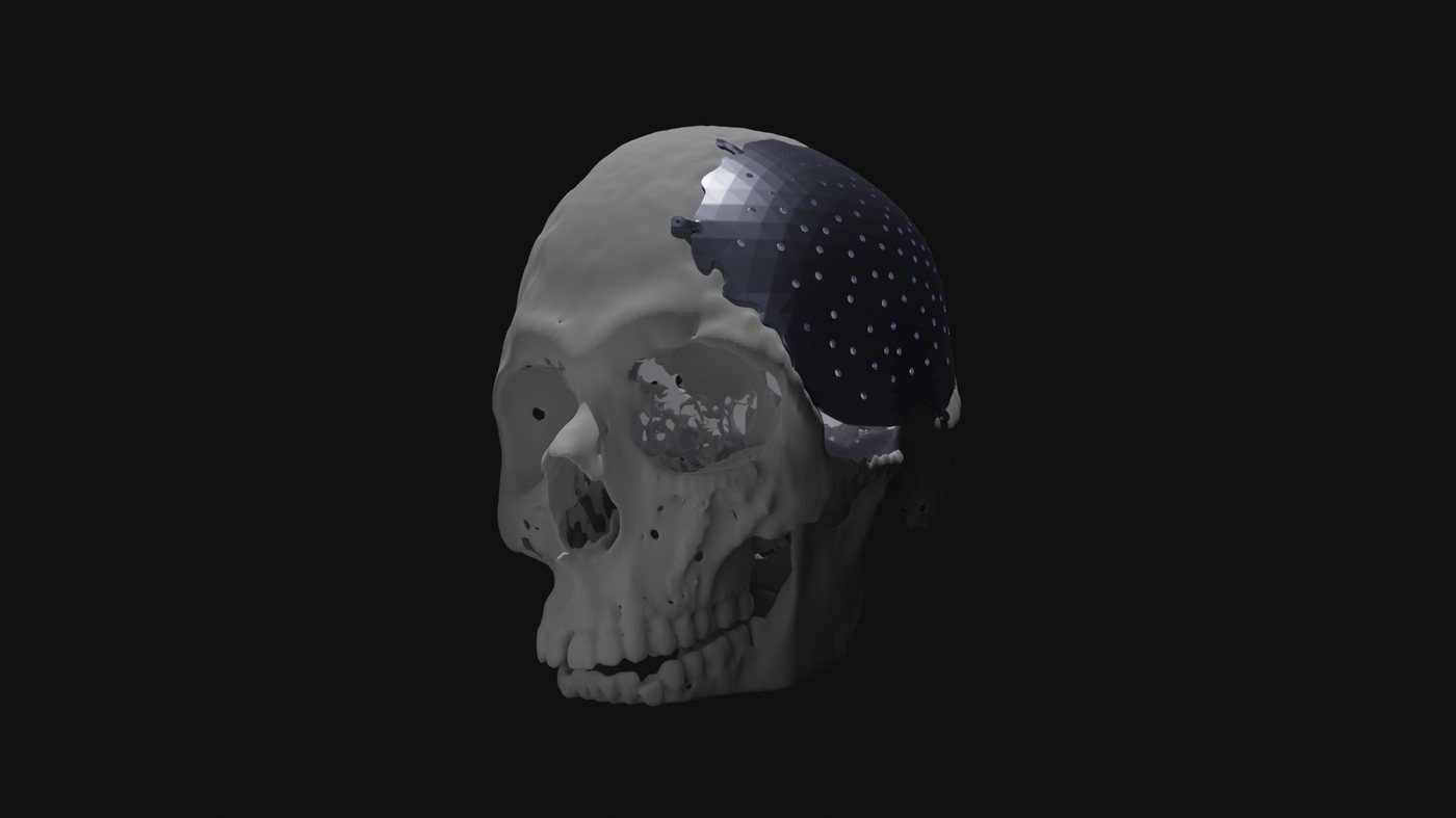 Three-quarter view of the skull with the large perforated implant fitted over the left fronto-parietal region