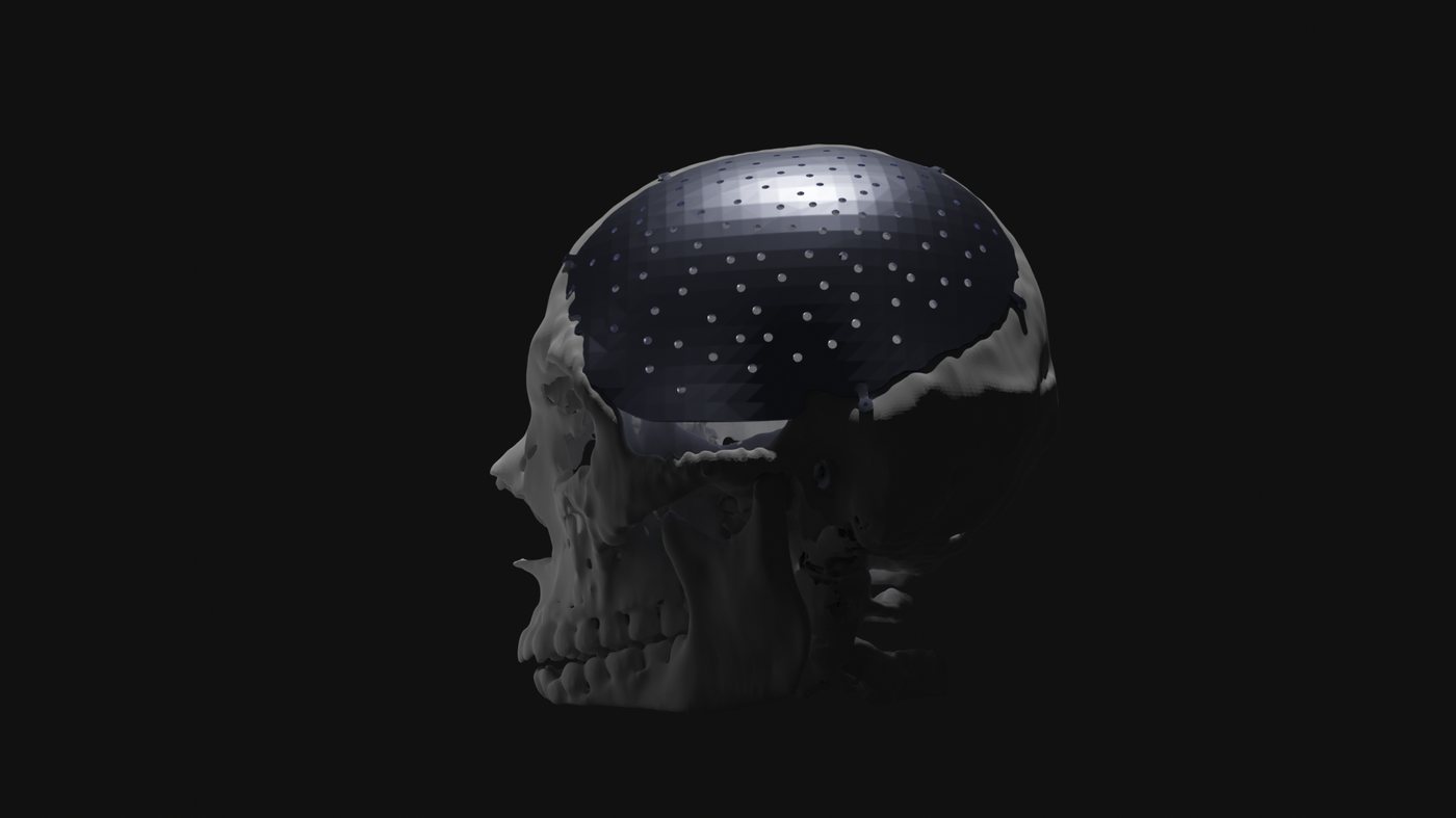 Lateral view of the skull showing the large perforated implant extending down through the temporal region