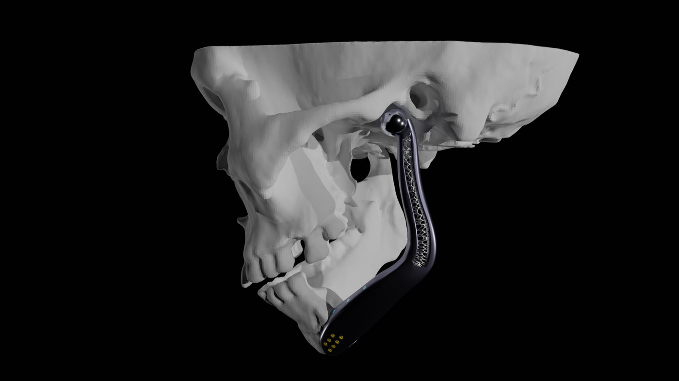 Frontal-angle view of the skull with the joint mechanism fitted