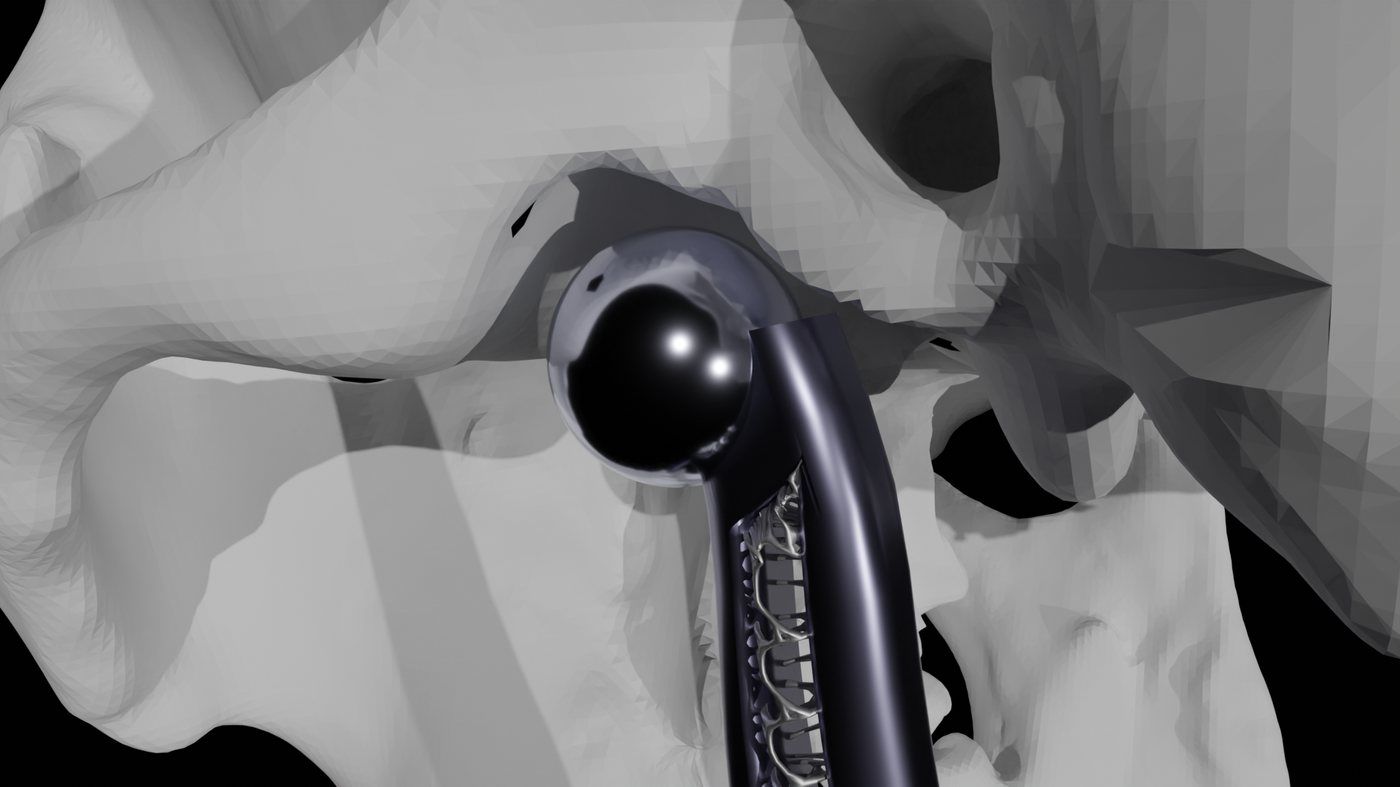Close-up of the polished ball head seated in the joint socket near the temporal bone