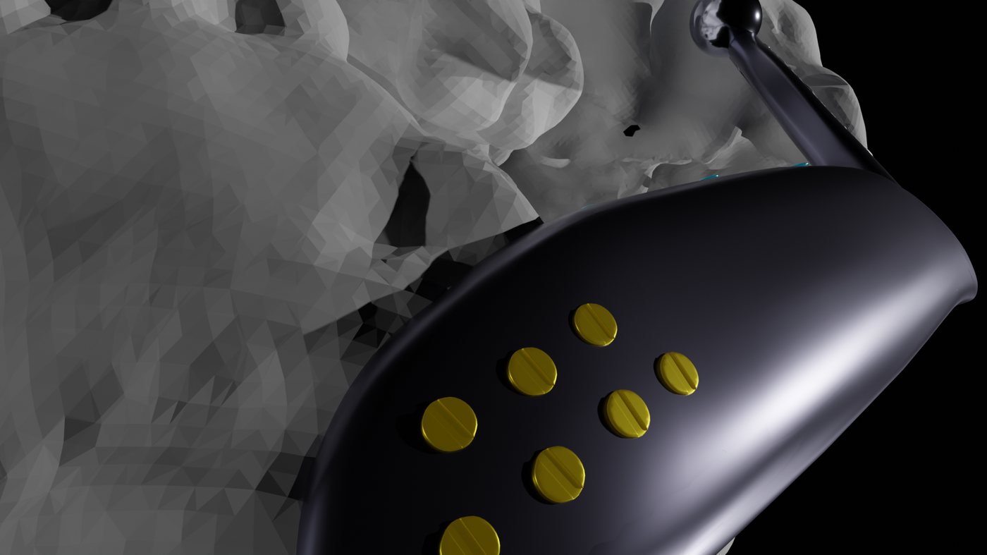 Close-up of the fixation footplate showing the screw hole pattern