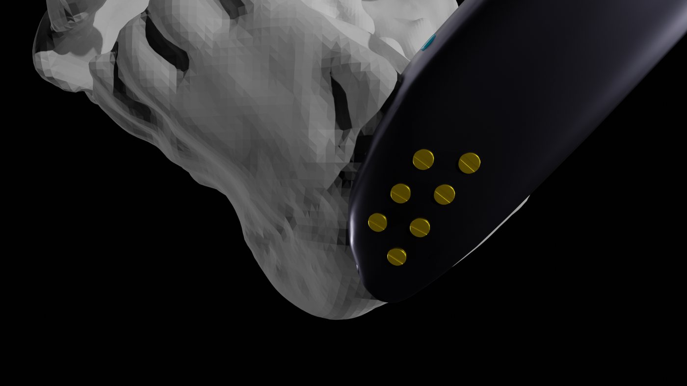 Angled close-up of the fixation footplate against the mandible