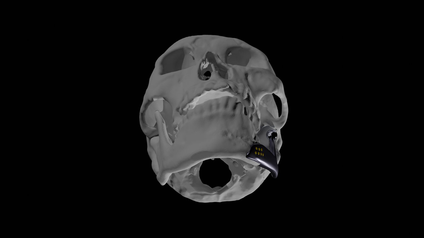 Inferior view of the skull showing the footplate and ball head from below