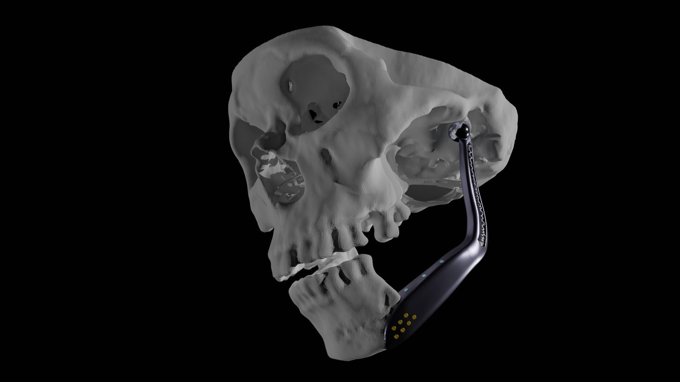 Skull with the experimental ball-and-socket jaw joint implant fitted in place